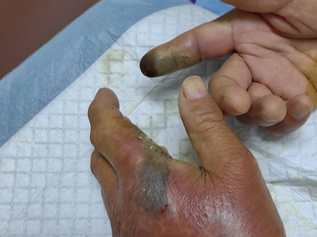 谢周三vs利兹联_眼镜王蛇咬伤老人谢周三vs利兹联，家属拖两米多长的“凶手”冲进医院！“拎蛇就医”可取吗？