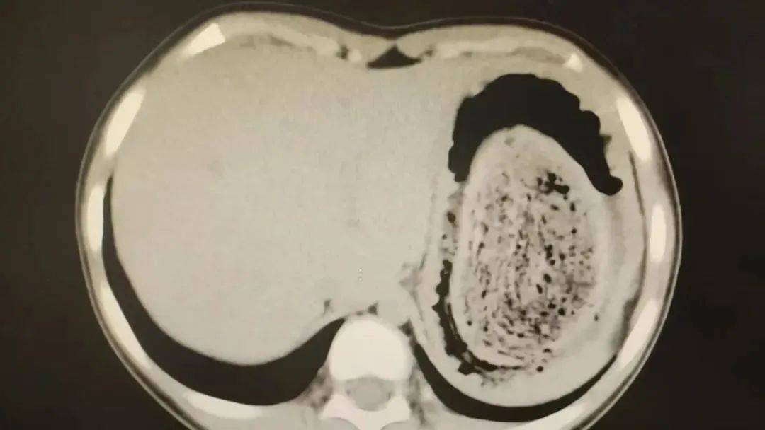 皇冠信用网账号申请_发现一例皇冠信用网账号申请，10岁女孩确诊！已有多起病例，有人因羞耻感延误就医